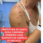 Prefeitura de Santa Rosa de Viterbo confirma o primeiro caso suspeito da varíola do macaco na cidade