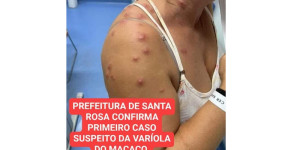 Prefeitura de Santa Rosa de Viterbo confirma o primeiro caso suspeito da varíola do macaco na cidade