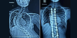 Santa Casa faz 1ª cirurgia de escoliose grave neuromonitorizada pelo SUS em São Carlos