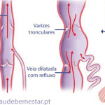 4 dicas para tratamento de varizes no inverno