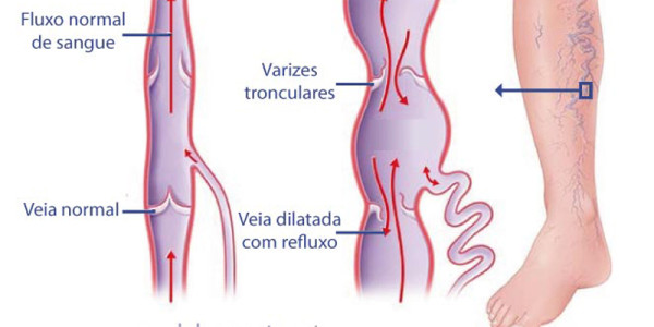 4 dicas para tratamento de varizes no inverno